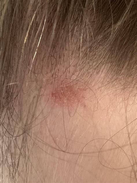 Itchy flakey scalp : r/DermatologyQuestions