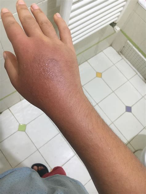 Why my hands are becoming like this , doctor didn’t know the cause : r