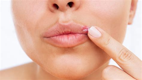 itchy lip