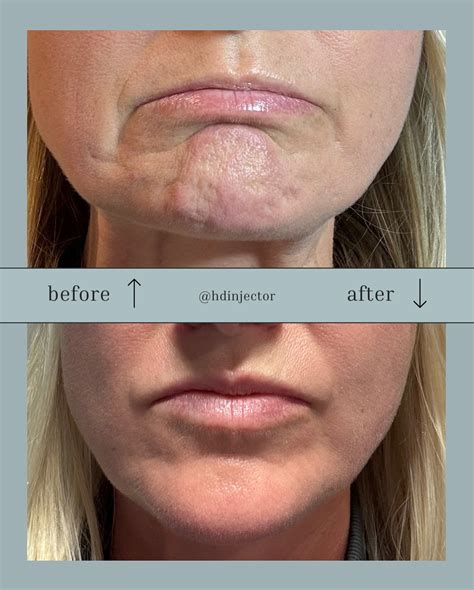 botox slim face 3