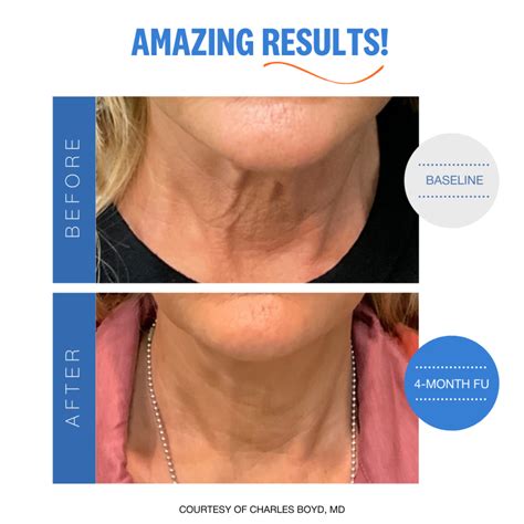 sofwave skin lifting tightening