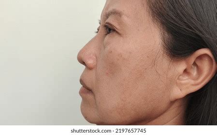 Portrait Showing Blemish Acne Skin On Stock Photo 2197657745 | Shutterstock