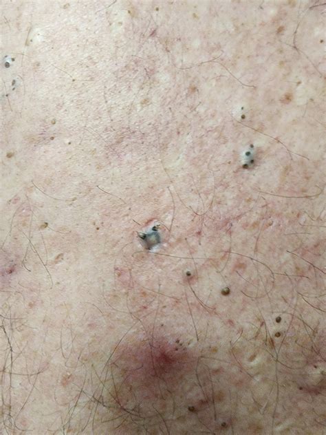 Unbelievable Blackhead Removal 2024: Before And After Photos That Will Shock You! Image 9