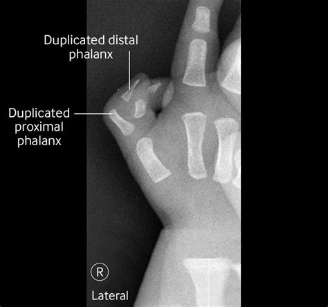 child   congenital hand anomaly  bmj