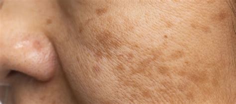 symptoms  melasma  face signs     pink foundry