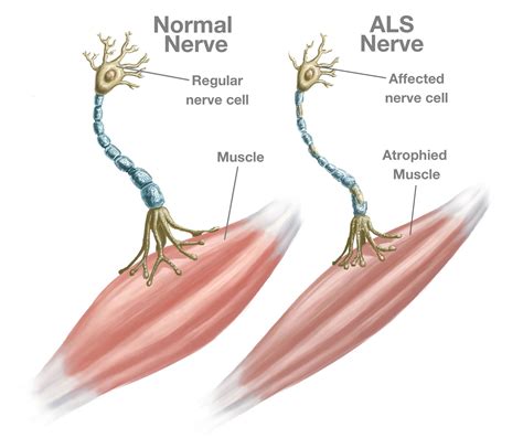 Amyotrophic Lateral Sclerosis Neuron