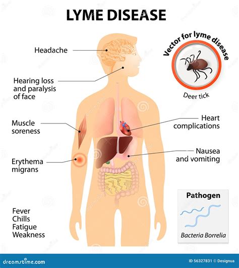 O Que É A Doença De Lyme - Doença De Lyme Ou Borreliosis De Lyme Ilustração do Vetor - Ilustração ...