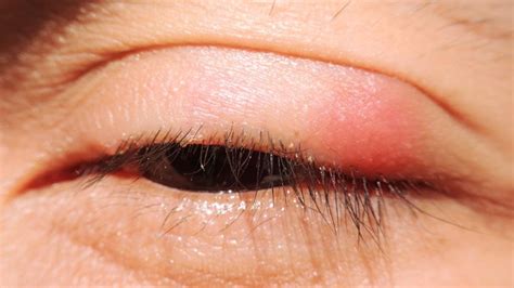 BLEPHARITIS