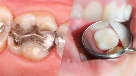 What is a composite dental filling?