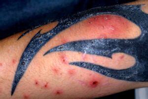 Foto De Tatuagem Inflamada