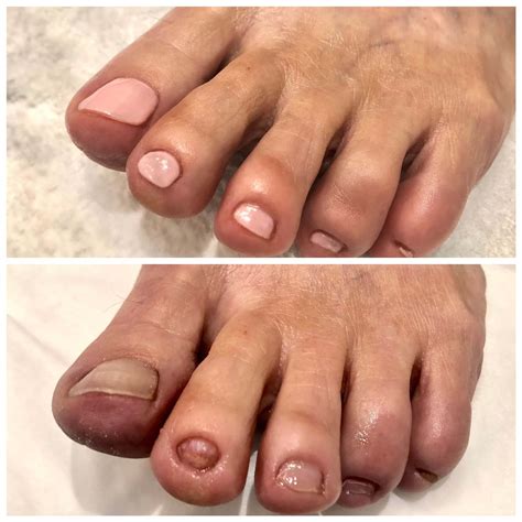 Nail Reconstruction Treatment | Nails by Toe Bro