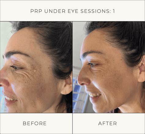 PRP Under Eye Treatment Professionals in Melbourne - Plasma Therapy
