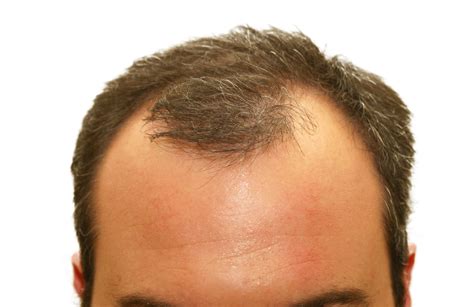 Say Goodbye to Hair Loss Hair Growth - Best Tips and Treatments