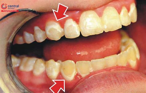 Bệnh viêm nha chu: nguyên nhân, chẩn đoán và điều trị