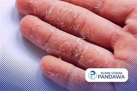 kulit tangan mengelupas bikin risih   mengatasinya klinik