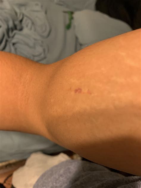 This is on my bicep. My bicep is extremely sore, I can barely use it. I