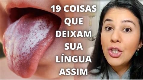 Lingua Branca O'que Pode Ser - Saburra lingual: Descubra 19 causas e como tratar LÍNGUA BRANCA e a ...