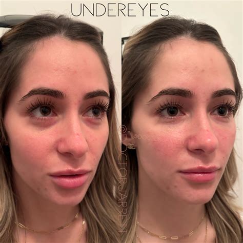 UnderEye Filler - Designer Aesthetics by Dr. Jarrett Schanzer | Miami