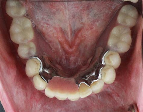 Lower Anterior Partial Denture