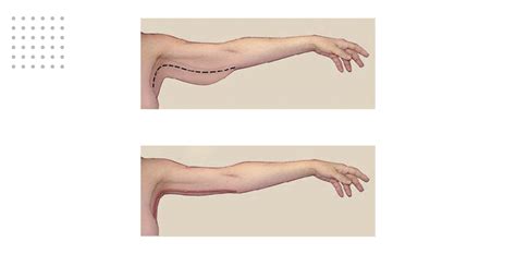 Braquioplastia Antes E Depois - Braquioplastia l Tudo sobre o Lifting de Braço - Dream Plastic