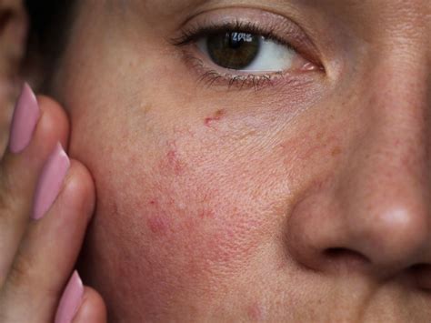How to Get Rid of Redness on Your Face, According to Dermatologists | SELF