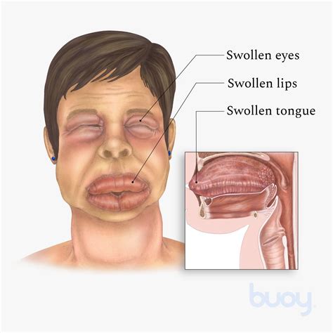 What Causes Swollen Lips And Eyes | Lipstutorial.org