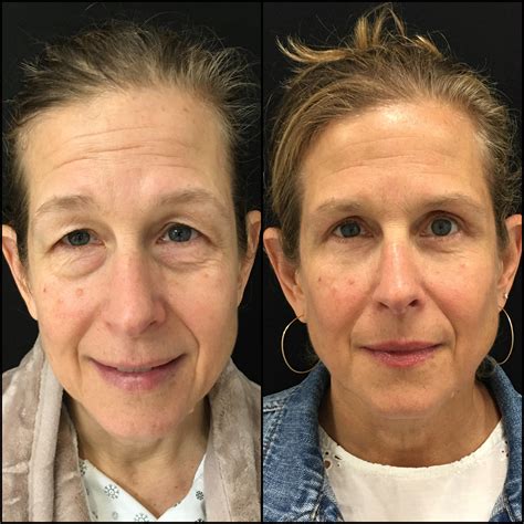 Lower Blepharoplasty Before & After Photos | Flora Levin MD