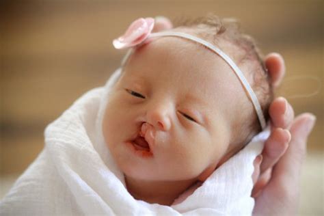 What you need to know about Patau .'s syndrome | Vinmec
