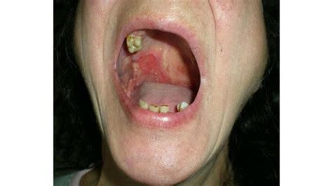 oral squamous cell carcinoma mouth cancer symptoms