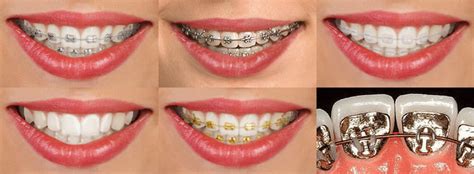 Types of Braces in Everett, MA | Everett Orthodontics