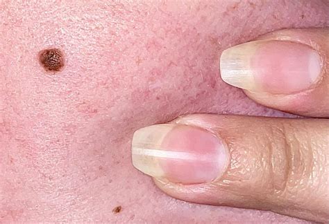 Canadian w/ face (cheek) mole : r/Melanoma