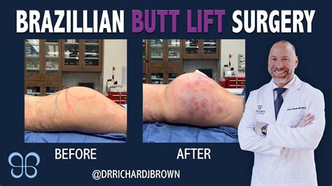 houston plastic surgeons bbl  geri hodge blog