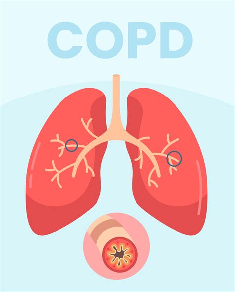 Chronic Obstructive Pulmonary Disease Copd