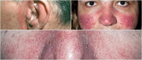 Treating Seborrheic Dermatitis on Face: Causes, Symptoms, Treatment ...