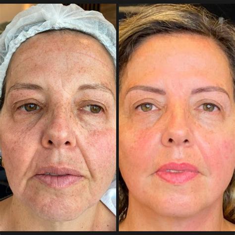 Revitalização Facial Antes E Depois