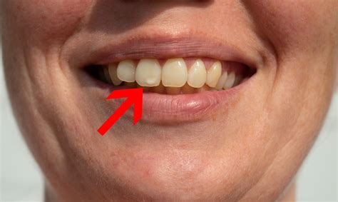 What Does a Cavity Look Like at Every Stage? (with Pictures)