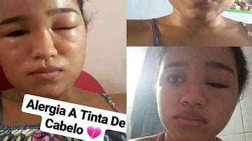 Que Remédio Tomar Para Alergia De Tinta De Cabelo - O que alivia alergia de tinta de cabelo?
