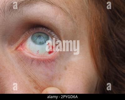 Subconjunctival hemorrhage or subconjunctival bleeding, hyposhagmus ...