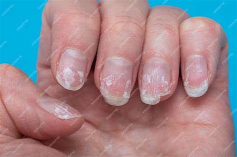 Unha Descamando E Quebradiça - Unhas quebradiças e mordidas escamosas sem manicure Cutícula de unha ...
