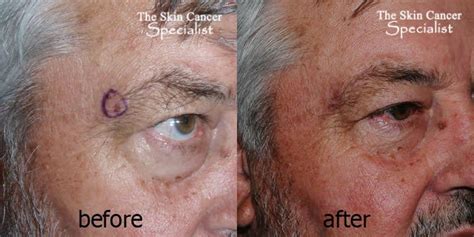 Laser Skin Cancer Therapy Treatment Surgery - Dr Peter Kim - Dr Peter ...