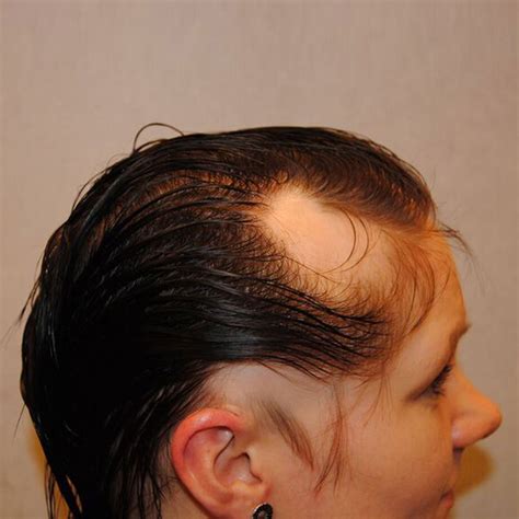 Bald Spot / Patches Hair Pieces (non surgical hair replacement bald spot)