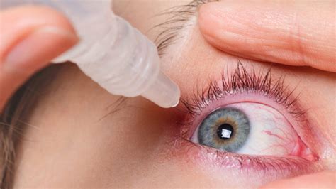 Alergia No Olho O Que Fazer - Alergia no olho: 5 dicas valiosas para controlar a alergia no olho ...