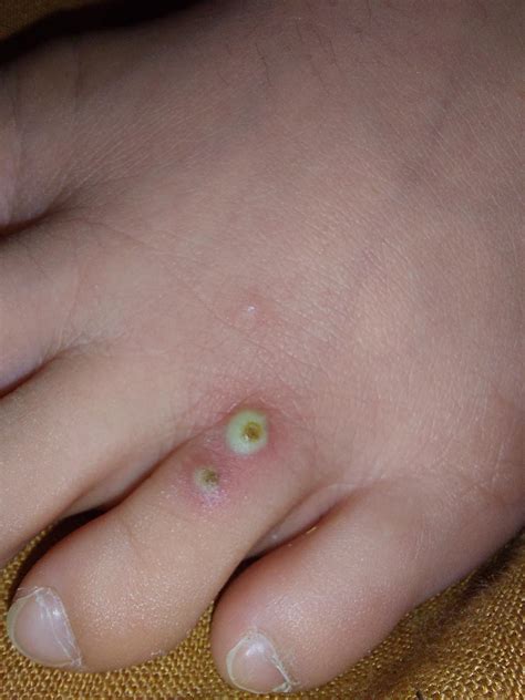 Can warts go away naturally? : r/Warts
