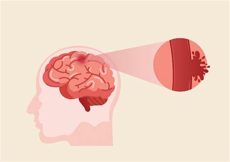 premium vector human brain stroke illustration