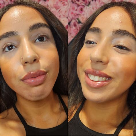 How much are Lip Filler in NJ | Lip Injections NJ - Berlin Beauty