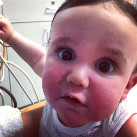 Allergic Reaction In Toddlers