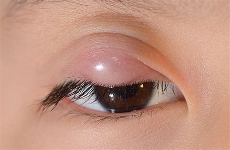 HOW TO TREAT PIMPLES ON EYE LID NATURALLY - Health GadgetsNG