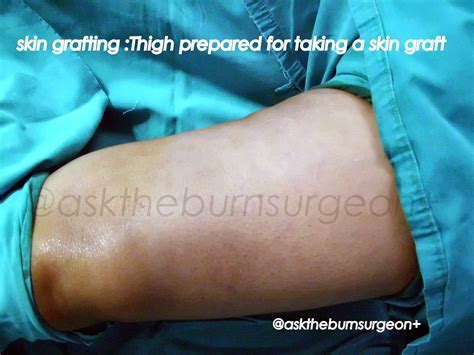 Ask The Burn Surgeon +For Free+: Doc, what is skin grafting ? - part II ...