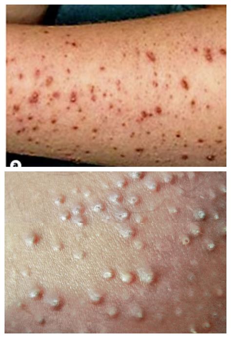 EFFECTS OF DEFICIENCY OF VITAMIN A ON HEALTH: - Health, Diet and ...