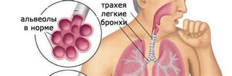VseParazity Микоплазма пневмония: симптомы и лечение у взрослых